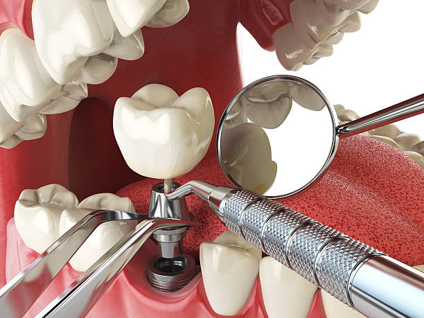 Best Emergency Tooth Extraction in Waukee, IA